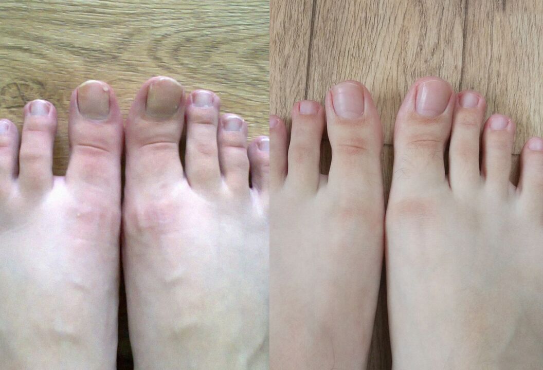 Antes e despois do tratamento, o fungo Promisil crema
