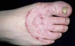 Os motivos da aparición do fungo nas pernas