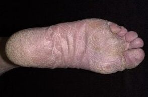 Signos e síntomas de fungo nas pernas