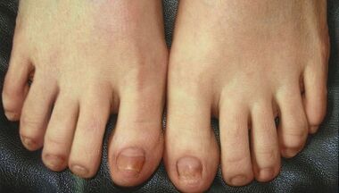 Etapas do desenvolvemento do fungo das uñas