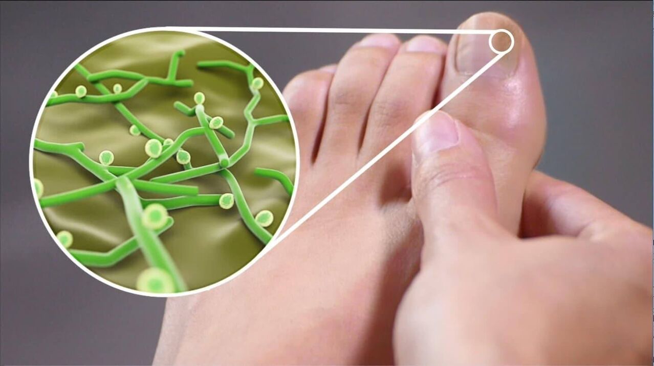 patóxenos dos fungos das unhas dos pés