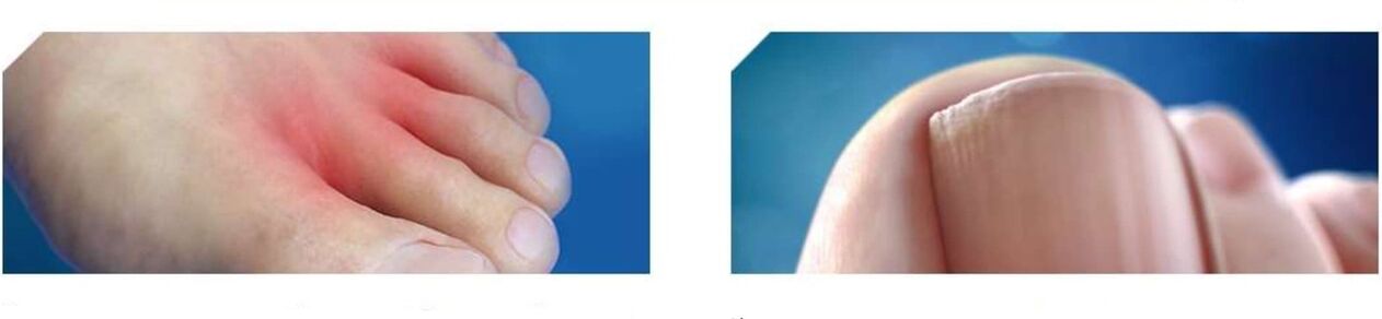 fase inicial de fungo no pé